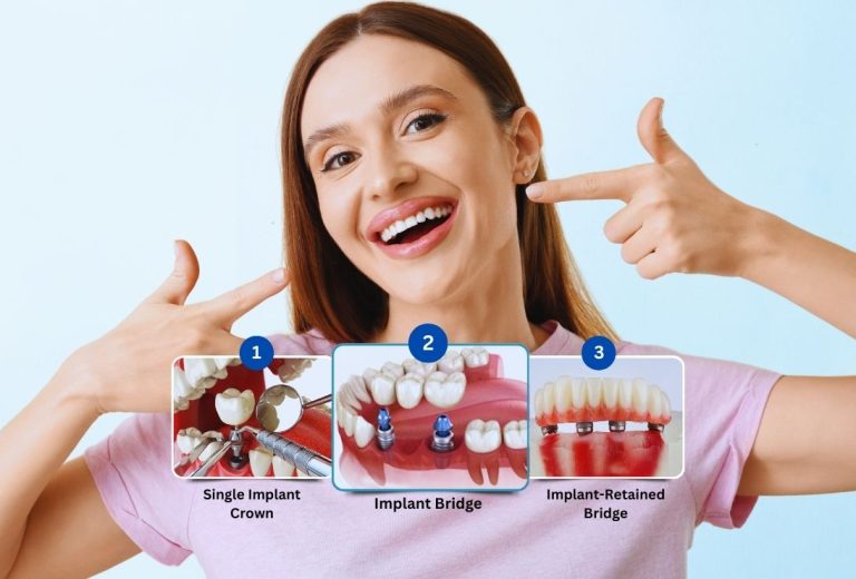 Understanding Dental Implants: A Guide to Decision Clarity & Planning